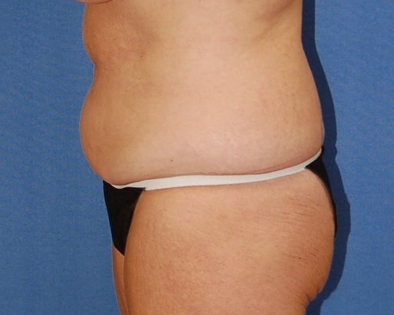 Tummy Tuck Before & After Gallery - Patient 89988144 - Image 5