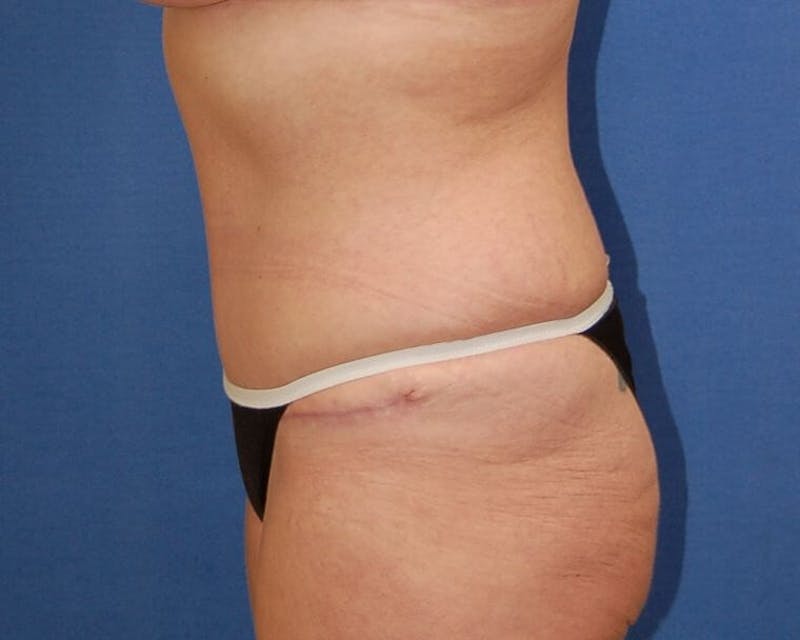 Tummy Tuck Before & After Gallery - Patient 89988144 - Image 6