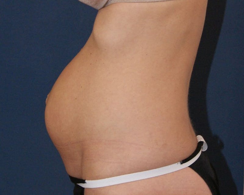 Tummy Tuck Before & After Gallery - Patient 89988145 - Image 1