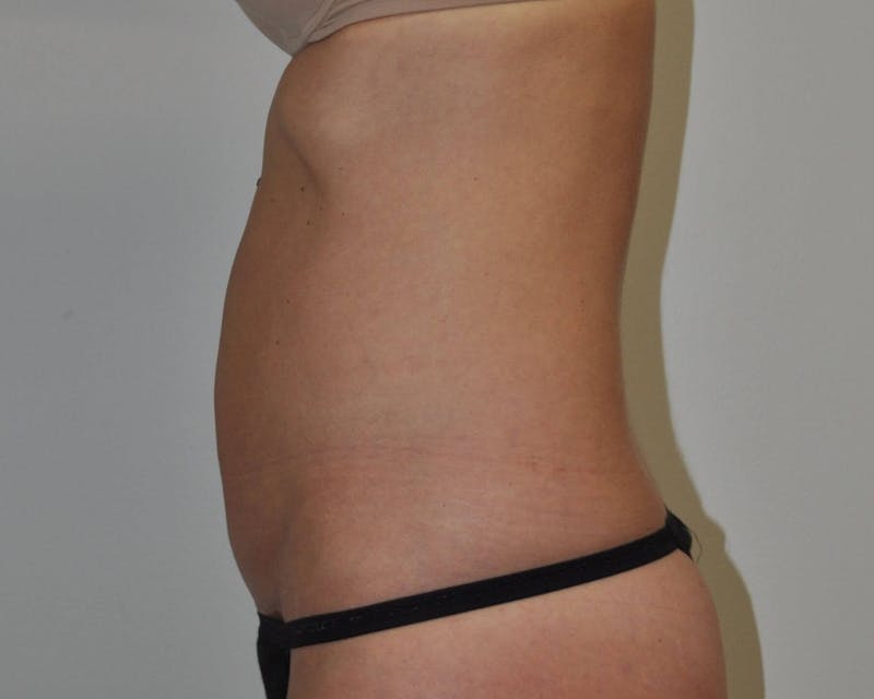 Tummy Tuck Before & After Gallery - Patient 89988145 - Image 2