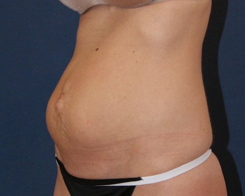 Tummy Tuck Before & After Gallery - Patient 89988145 - Image 3