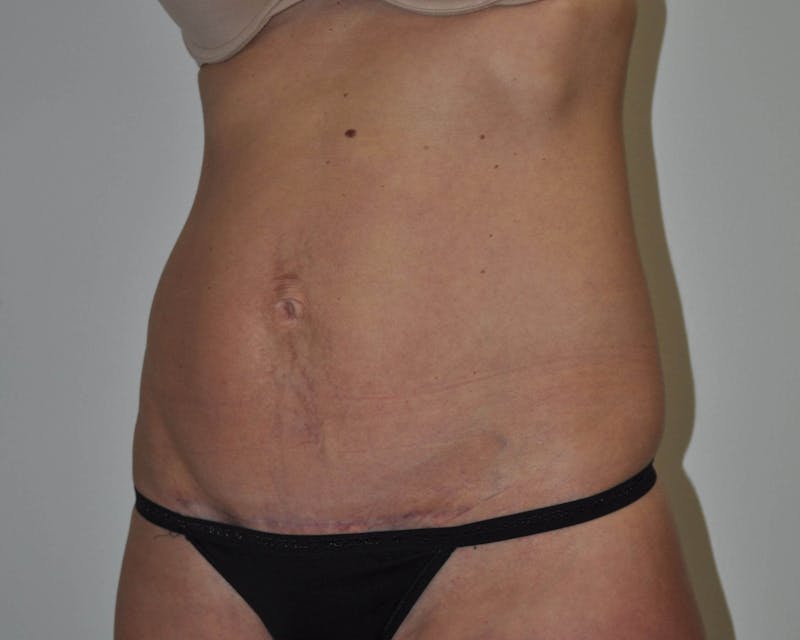 Tummy Tuck Before & After Gallery - Patient 89988145 - Image 4