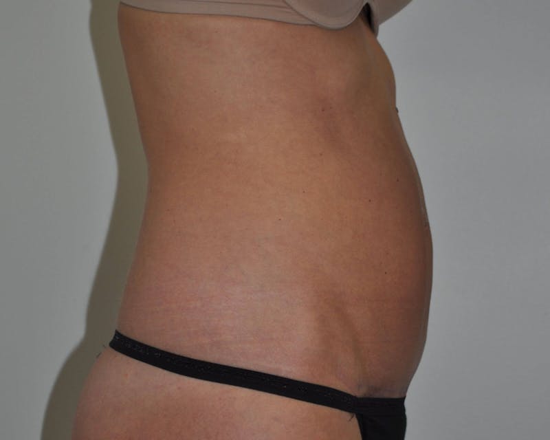 Tummy Tuck Before & After Gallery - Patient 89988145 - Image 6