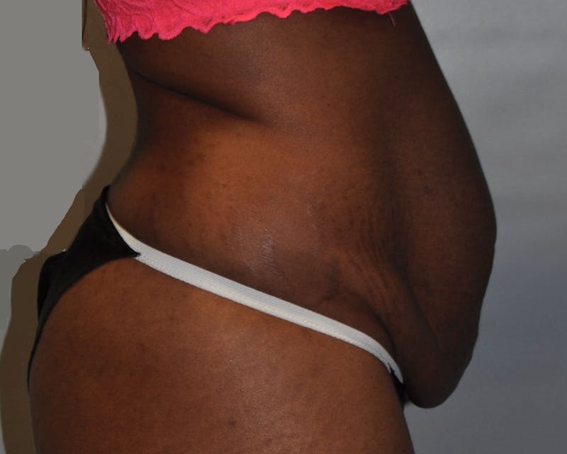 Tummy Tuck Before & After Gallery - Patient 89988146 - Image 5