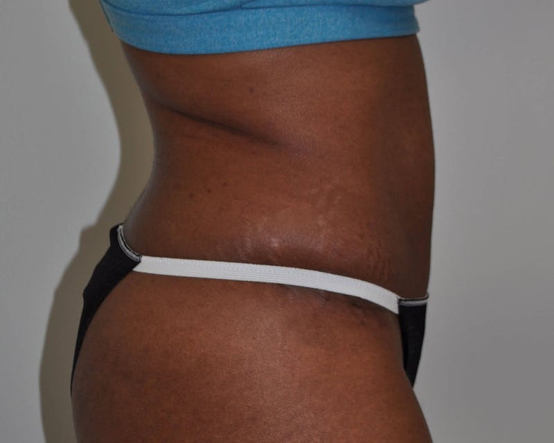 Tummy Tuck Before & After Gallery - Patient 89988146 - Image 6