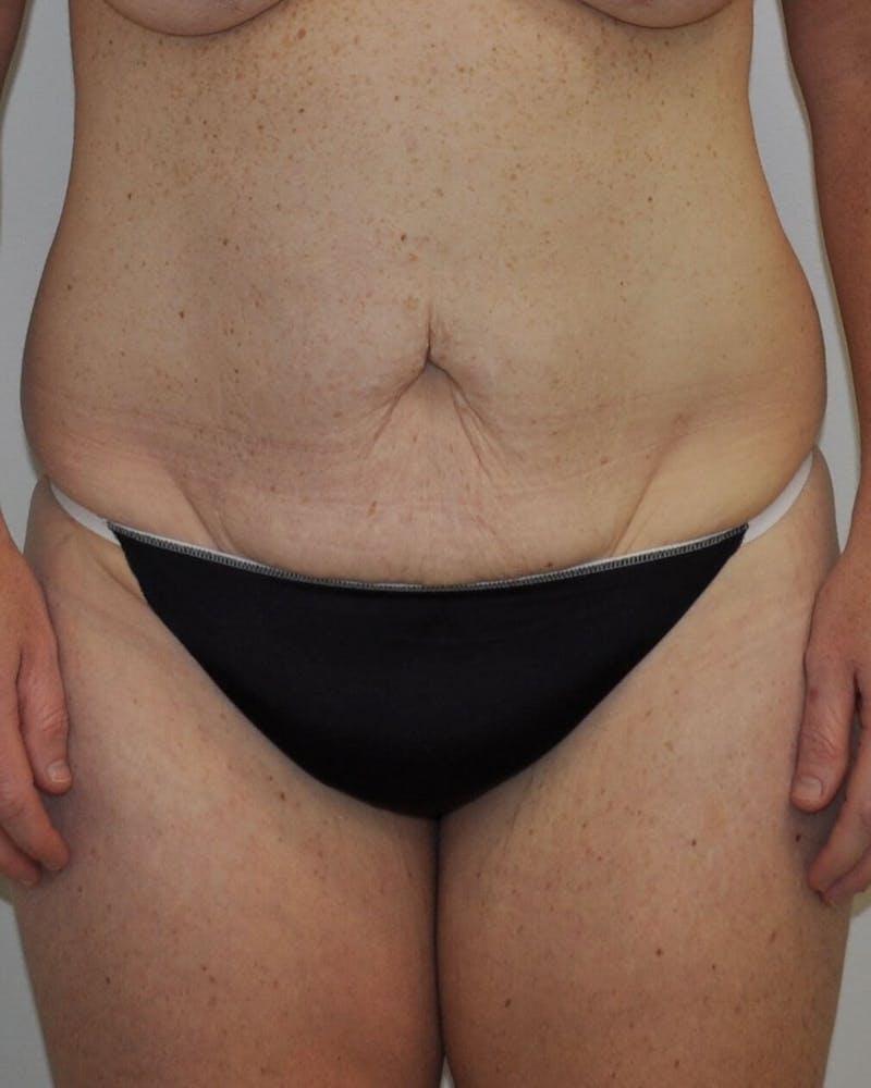 Tummy Tuck Before & After Gallery - Patient 89988147 - Image 1