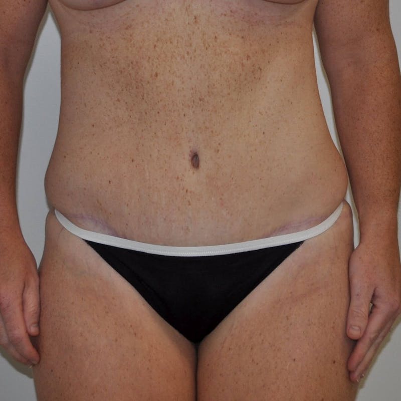 Tummy Tuck Before & After Gallery - Patient 89988147 - Image 2
