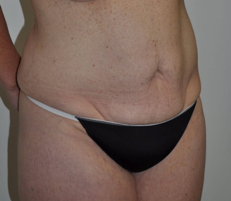 Tummy Tuck Before & After Gallery - Patient 89988147 - Image 3