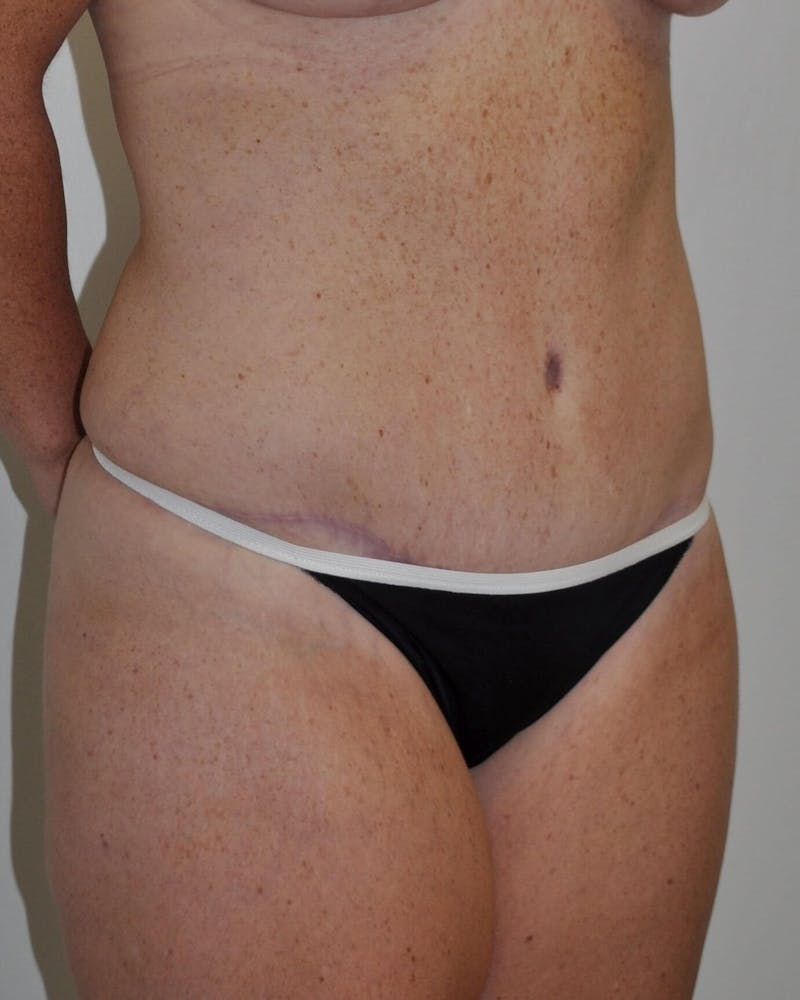 Tummy Tuck Before & After Gallery - Patient 89988147 - Image 4
