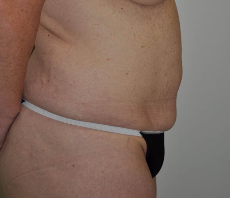 Tummy Tuck Before & After Gallery - Patient 89988147 - Image 5
