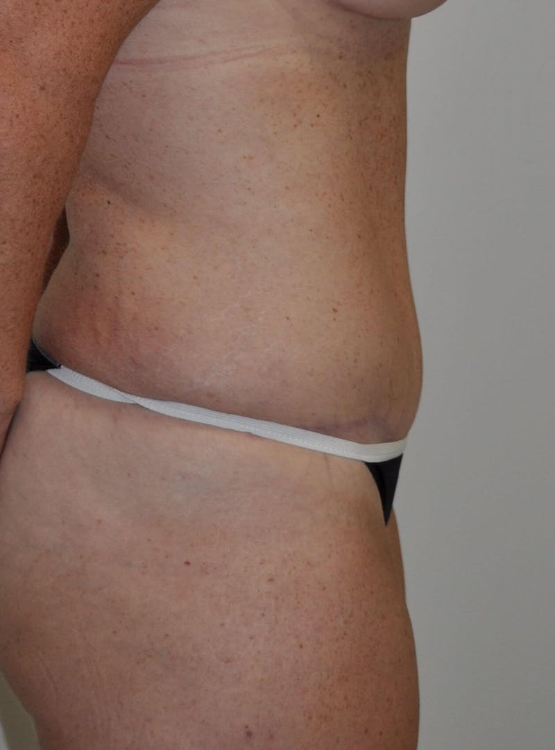 Tummy Tuck Before & After Gallery - Patient 89988147 - Image 6