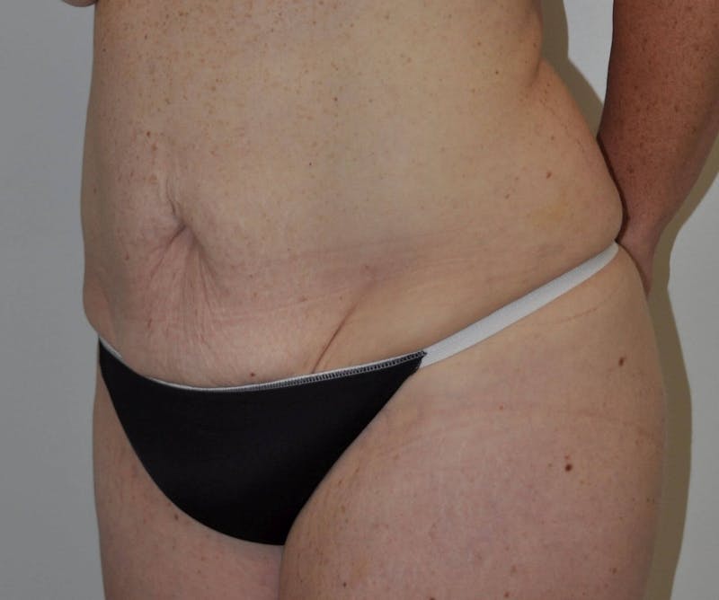 Tummy Tuck Before & After Gallery - Patient 89988147 - Image 7