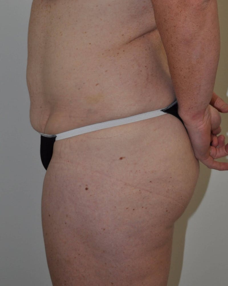 Tummy Tuck Before & After Gallery - Patient 89988147 - Image 9