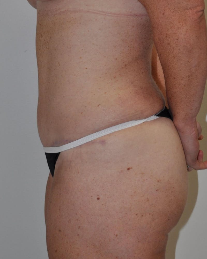 Tummy Tuck Before & After Gallery - Patient 89988147 - Image 10
