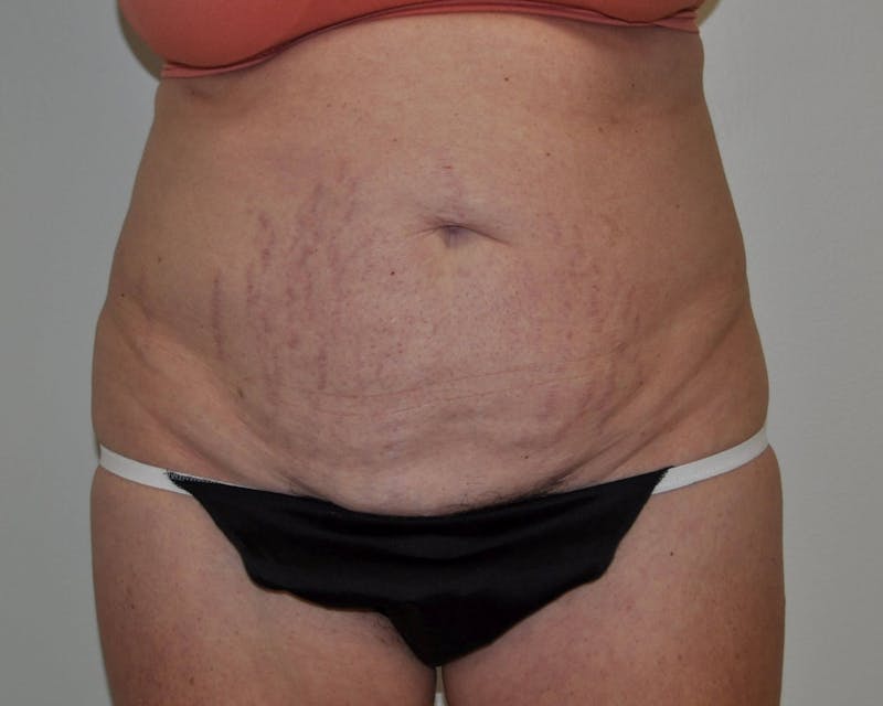 Tummy Tuck Before & After Gallery - Patient 89988148 - Image 1