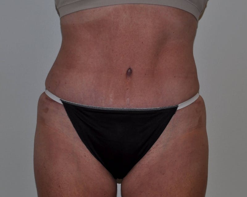 Tummy Tuck Before & After Gallery - Patient 89988148 - Image 2