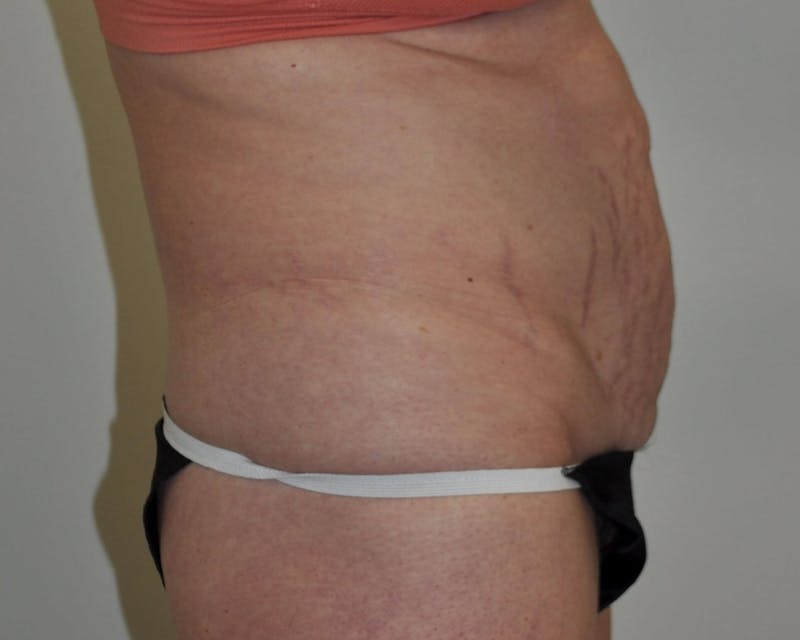 Tummy Tuck Before & After Gallery - Patient 89988148 - Image 3