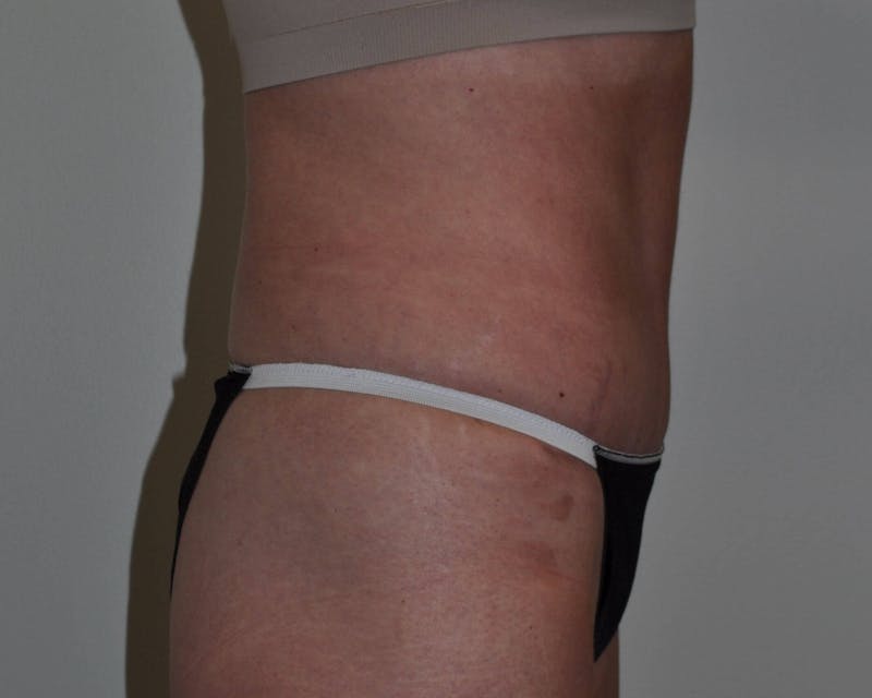 Tummy Tuck Before & After Gallery - Patient 89988148 - Image 4
