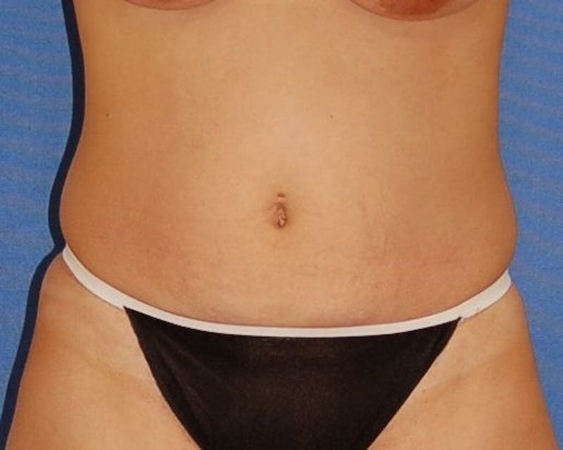 Tummy Tuck Before & After Gallery - Patient 89988150 - Image 1