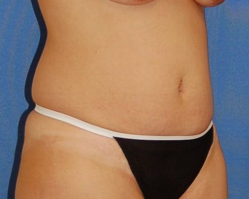 Tummy Tuck Before & After Gallery - Patient 89988150 - Image 3