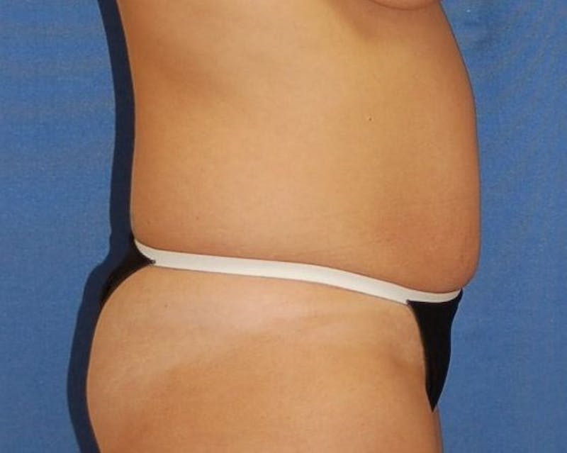 Tummy Tuck Before & After Gallery - Patient 89988150 - Image 5