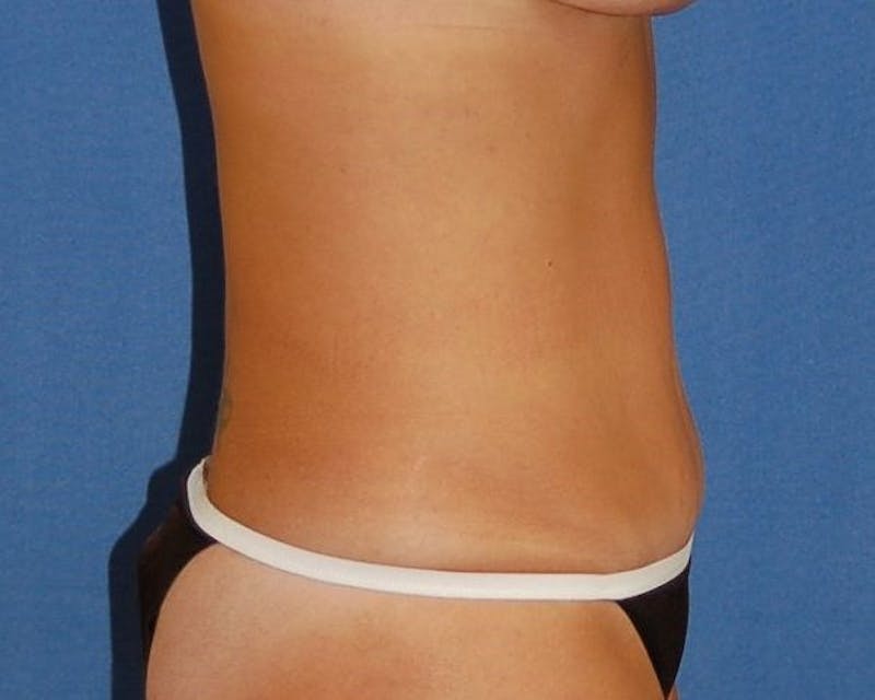 Tummy Tuck Before & After Gallery - Patient 89988150 - Image 6