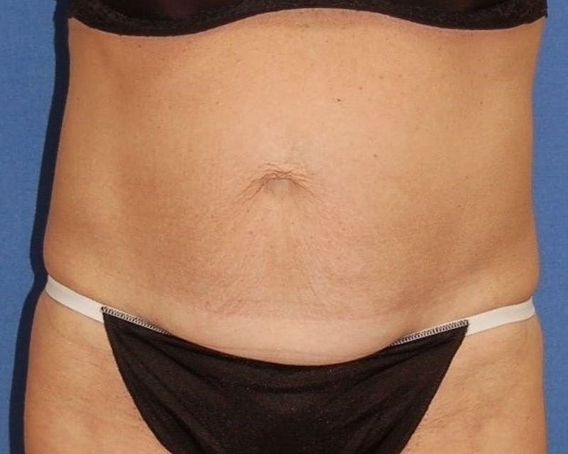 Tummy Tuck Before & After Gallery - Patient 89988152 - Image 1