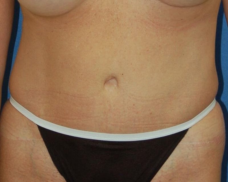 Tummy Tuck Before & After Gallery - Patient 89988152 - Image 2