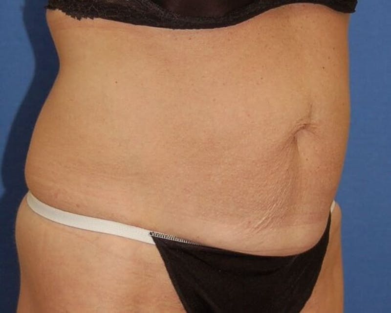 Tummy Tuck Before & After Gallery - Patient 89988152 - Image 3
