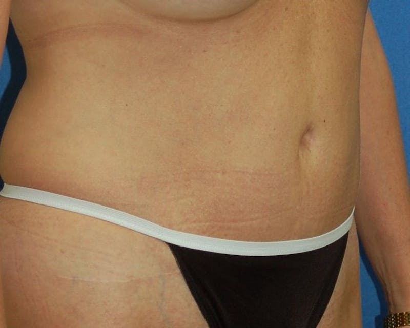 Tummy Tuck Before & After Gallery - Patient 89988152 - Image 4