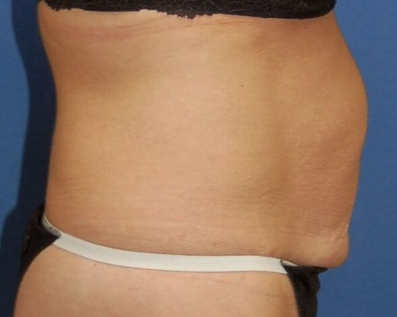Tummy Tuck Before & After Gallery - Patient 89988152 - Image 5