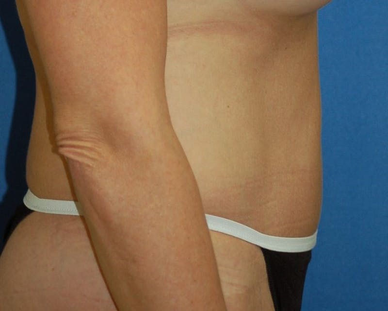 Tummy Tuck Before & After Gallery - Patient 89988152 - Image 6
