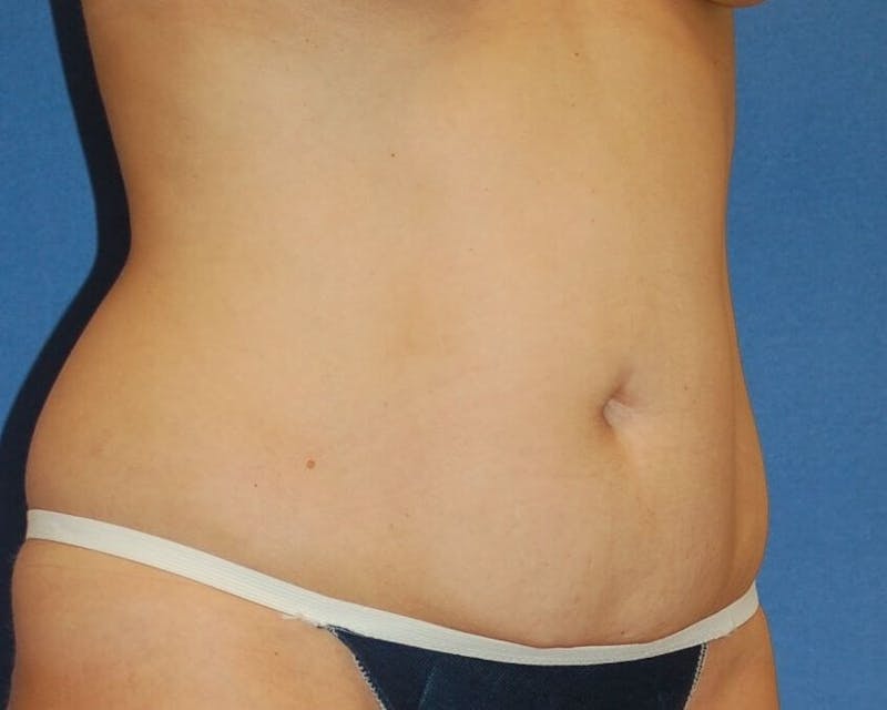 Tummy Tuck Before & After Gallery - Patient 89988153 - Image 3