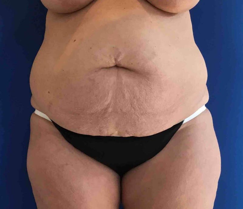 Tummy Tuck Before & After Gallery - Patient 89988154 - Image 1