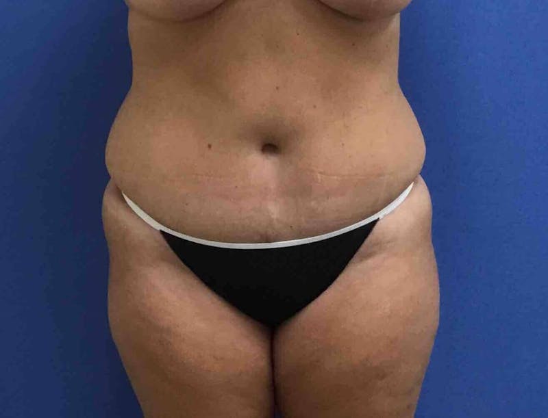 Tummy Tuck Before & After Gallery - Patient 89988154 - Image 2