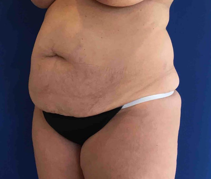 Tummy Tuck Before & After Gallery - Patient 89988154 - Image 3