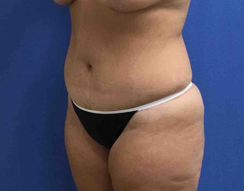 Tummy Tuck Before & After Gallery - Patient 89988154 - Image 4