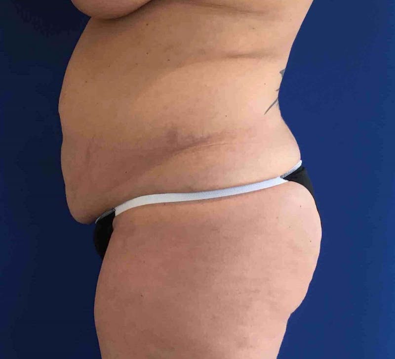 Tummy Tuck Before & After Gallery - Patient 89988154 - Image 5