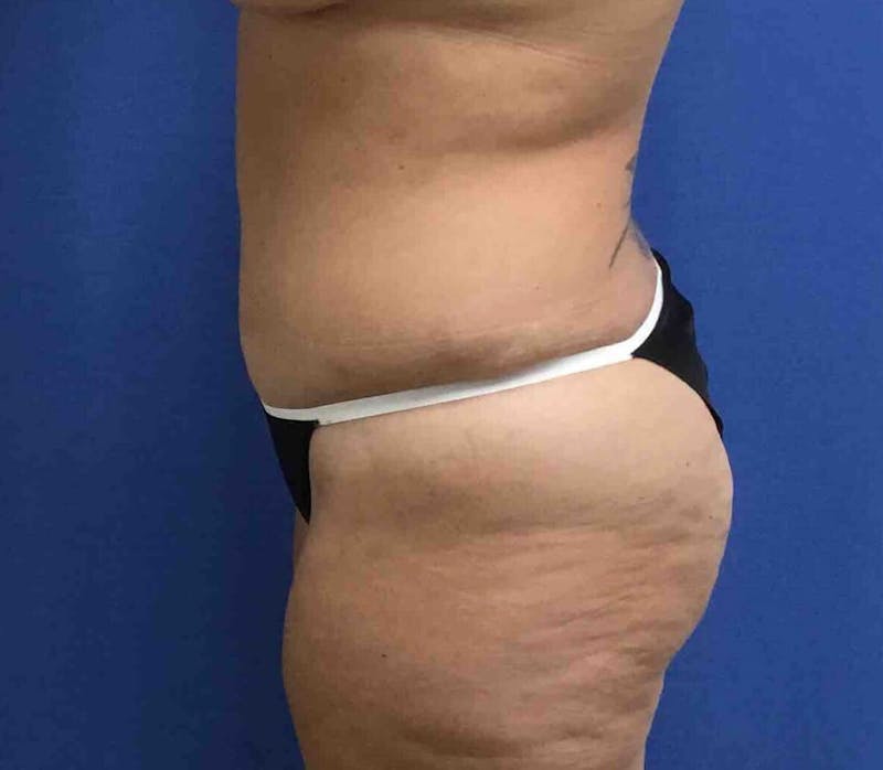Tummy Tuck Before & After Gallery - Patient 89988154 - Image 6