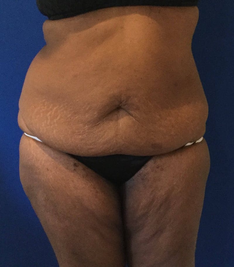 Tummy Tuck Before & After Gallery - Patient 89988158 - Image 1