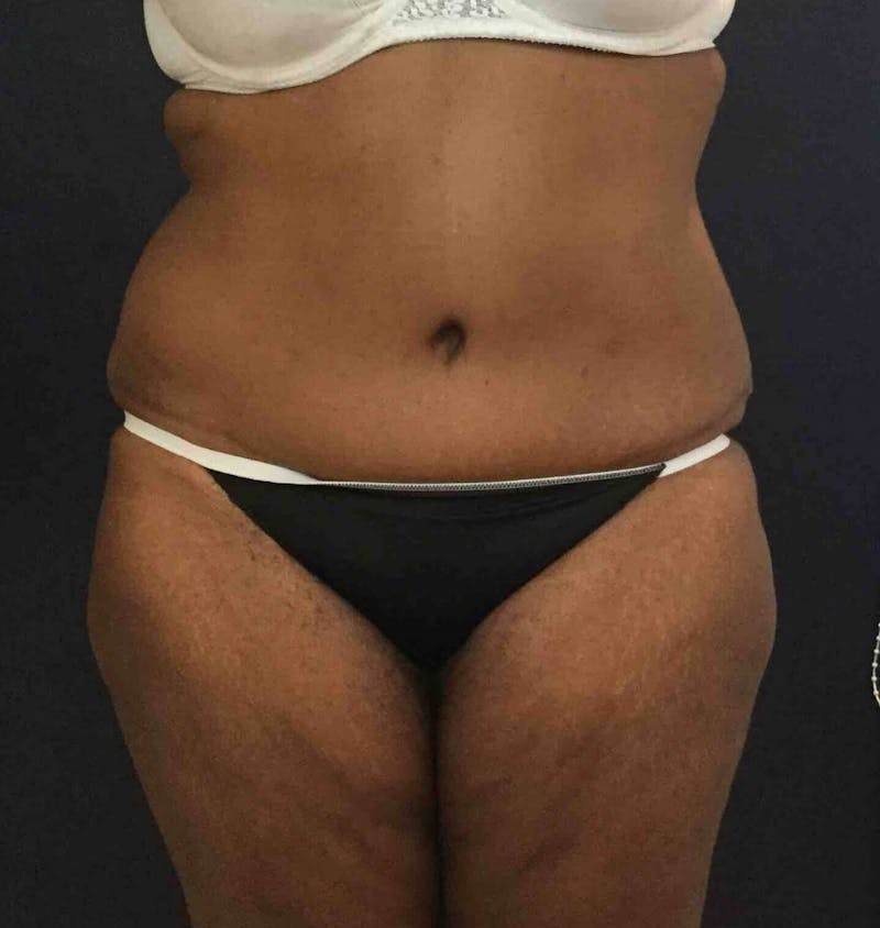 Tummy Tuck Before & After Gallery - Patient 89988158 - Image 2