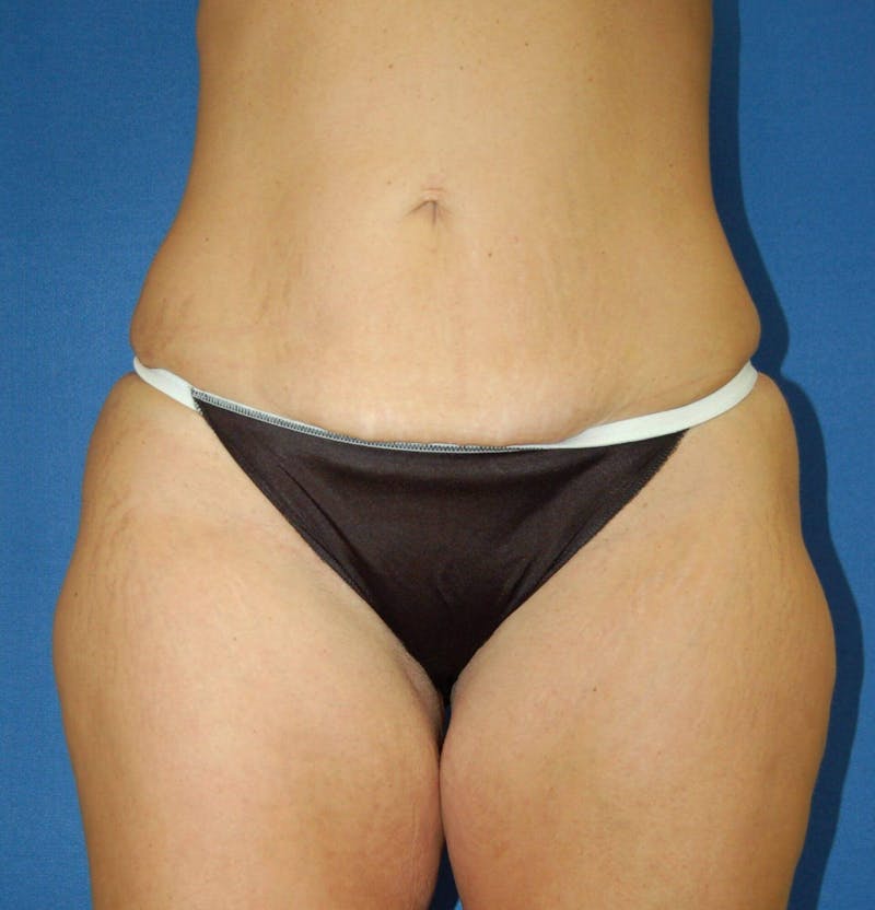 Tummy Tuck Before & After Gallery - Patient 89988299 - Image 1