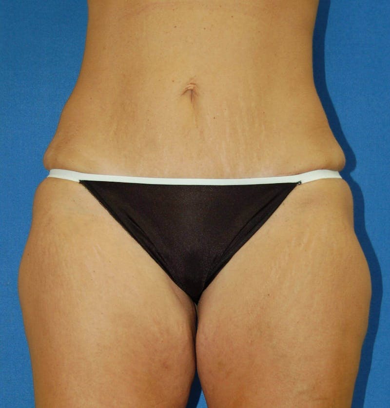 Tummy Tuck Before & After Gallery - Patient 89988299 - Image 2