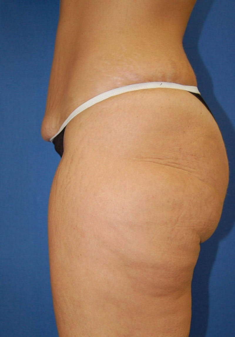 Tummy Tuck Before & After Gallery - Patient 89988299 - Image 3
