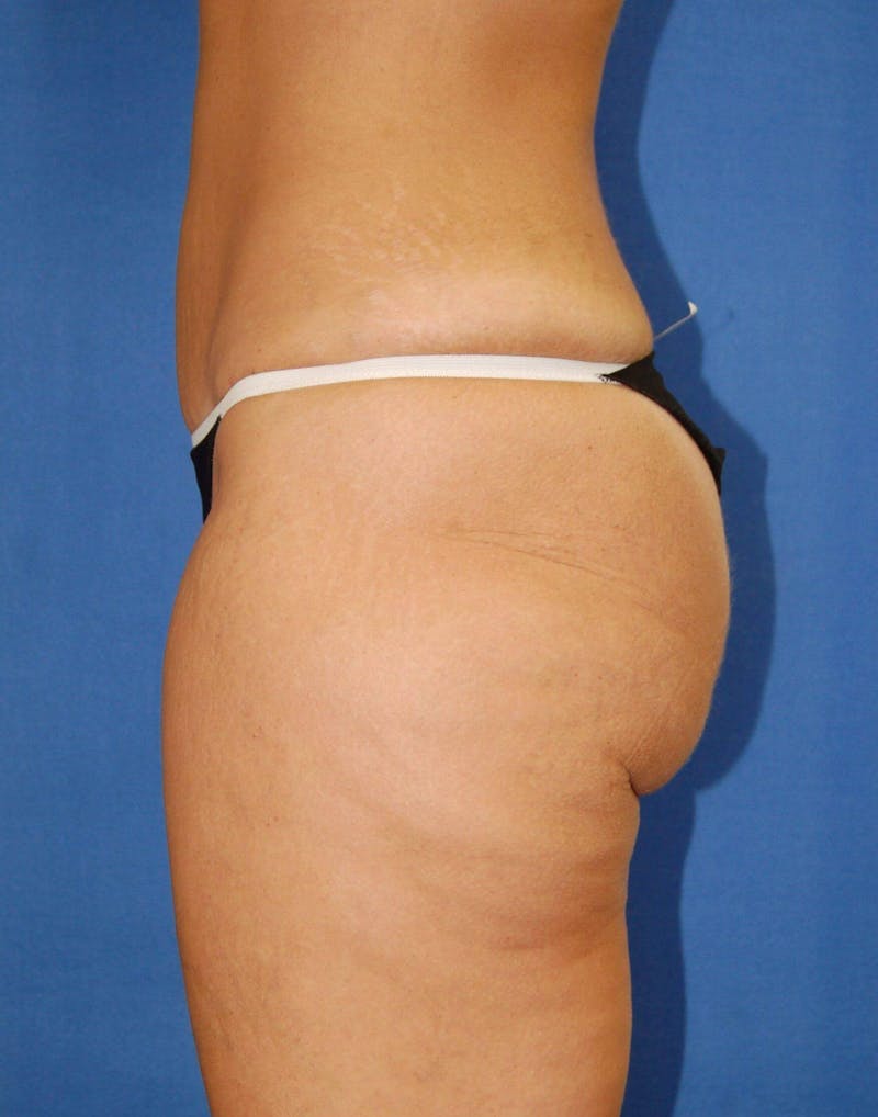 Tummy Tuck Before & After Gallery - Patient 89988299 - Image 4
