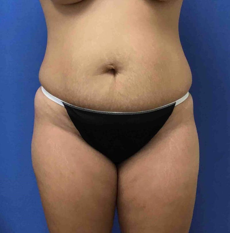 Tummy Tuck Before & After Gallery - Patient 89988305 - Image 1