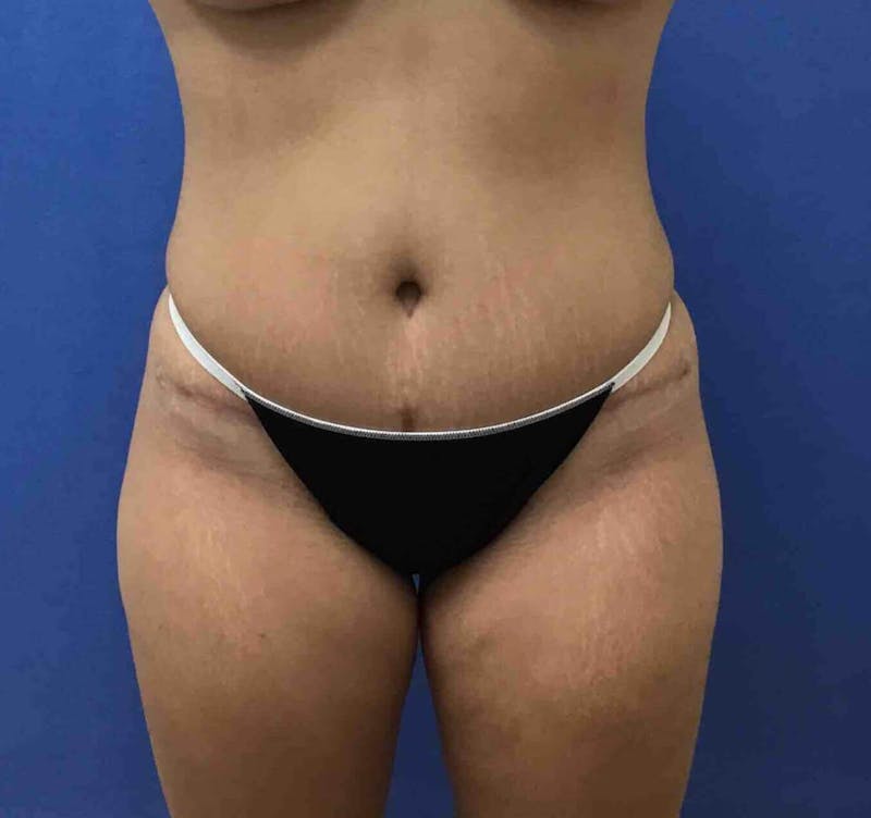 Tummy Tuck Before & After Gallery - Patient 89988305 - Image 2
