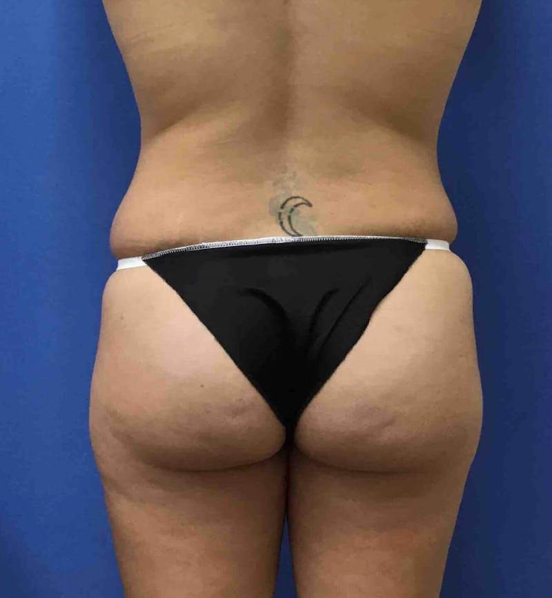 Tummy Tuck Before & After Gallery - Patient 89988305 - Image 3