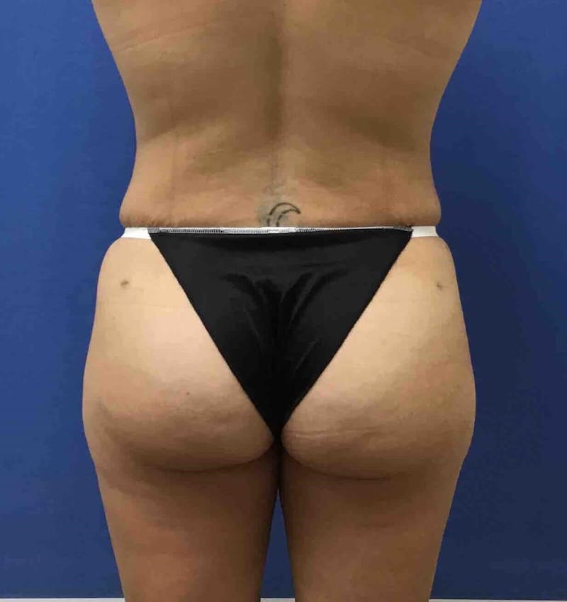 Tummy Tuck Before & After Gallery - Patient 89988305 - Image 4