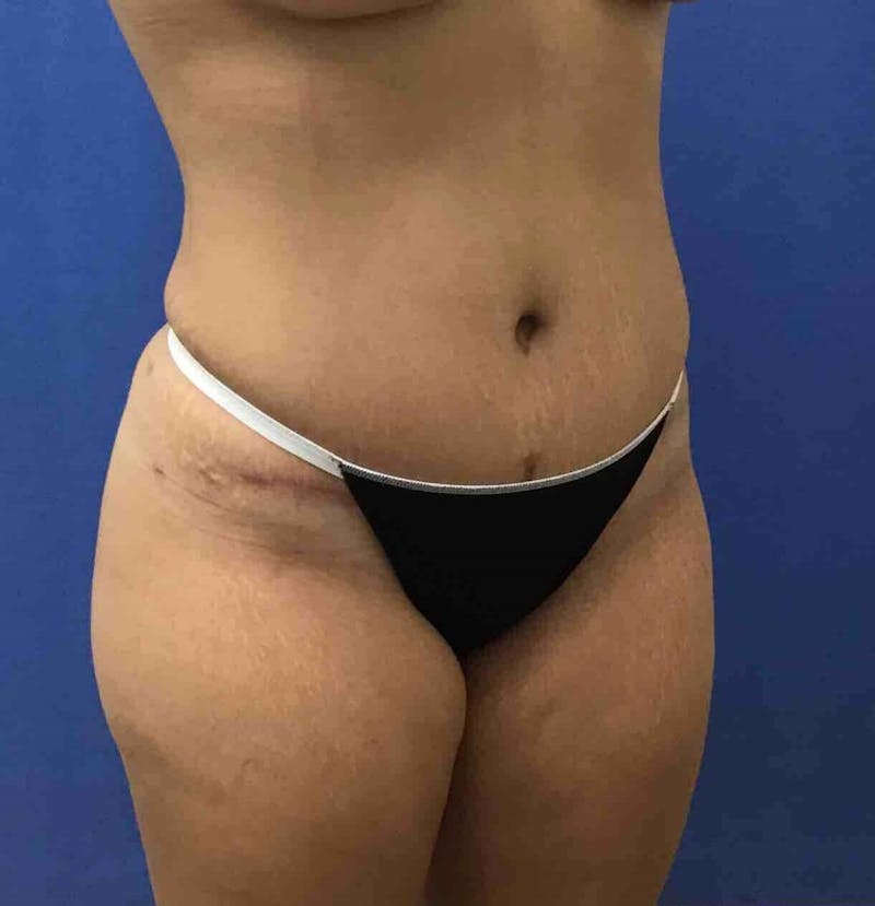 Tummy Tuck Before & After Gallery - Patient 89988305 - Image 6